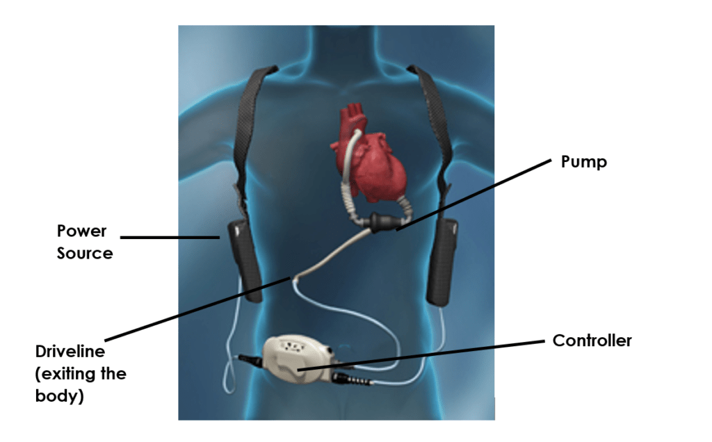 LVADs Minimizing Driveline Infections at Home Eloquest Healthcare, Inc.
