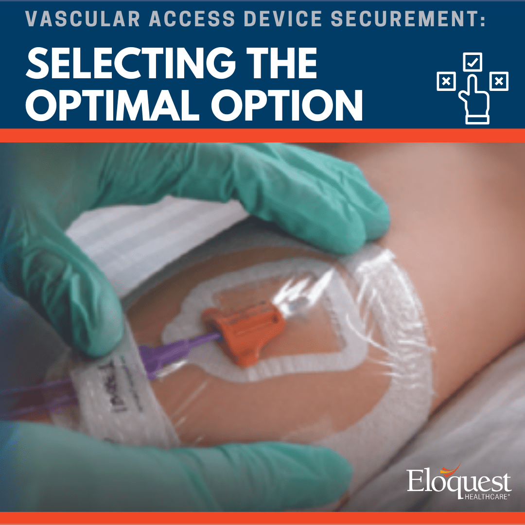 Test: Vascular Access Device Securement: Selecting the Optimal Option
